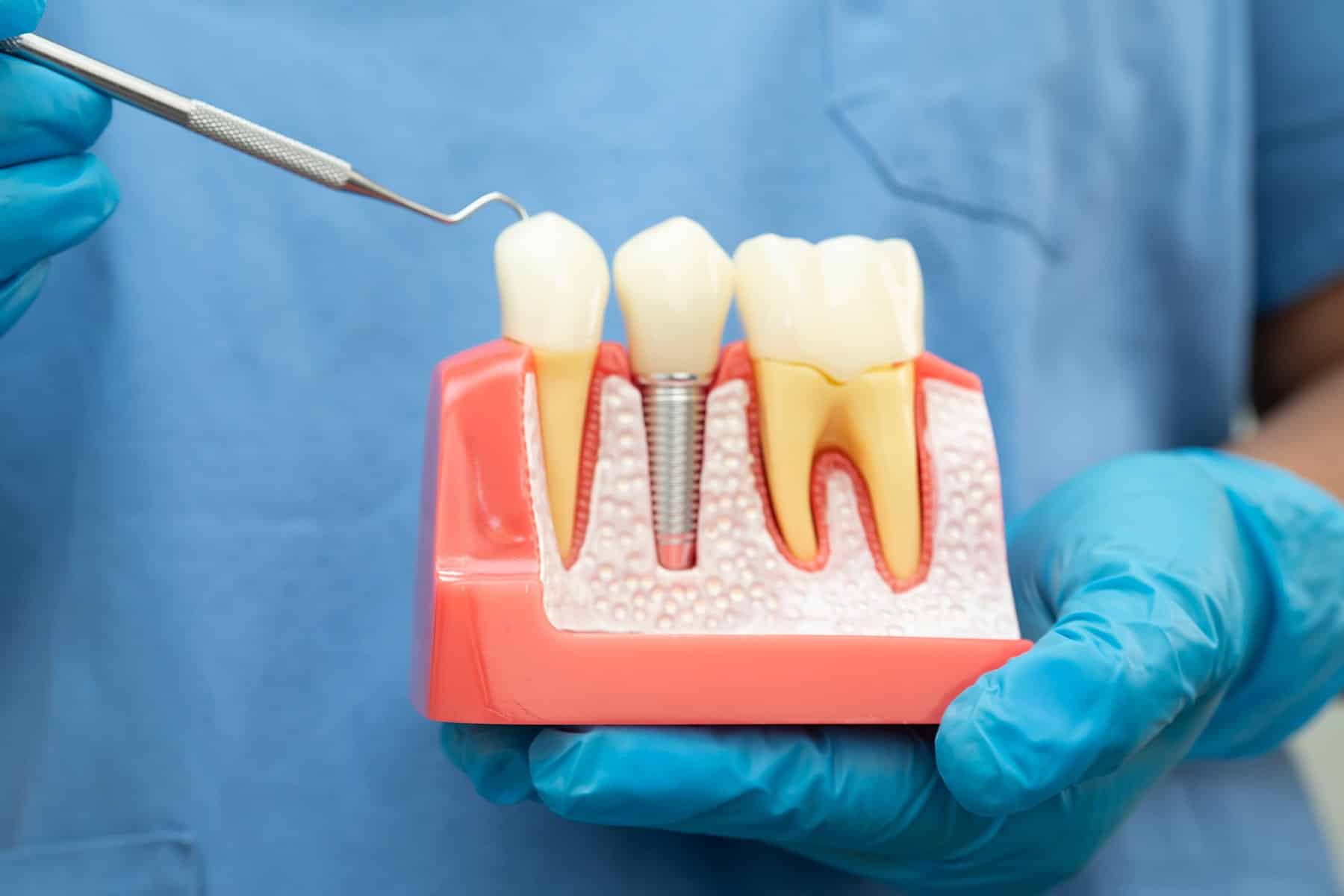 tooth Implant dentist in North Phoenix, AZ